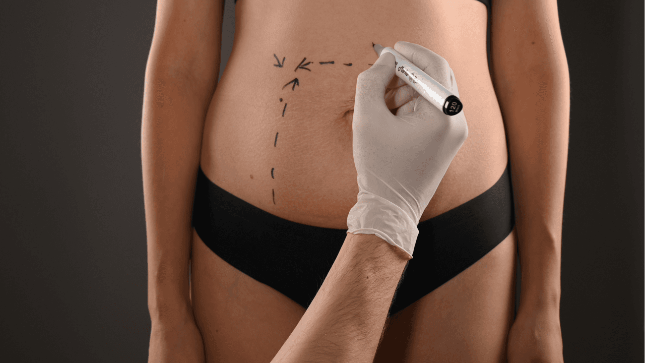 Best Liposuction in Korea | Best Clinics, Prices and More