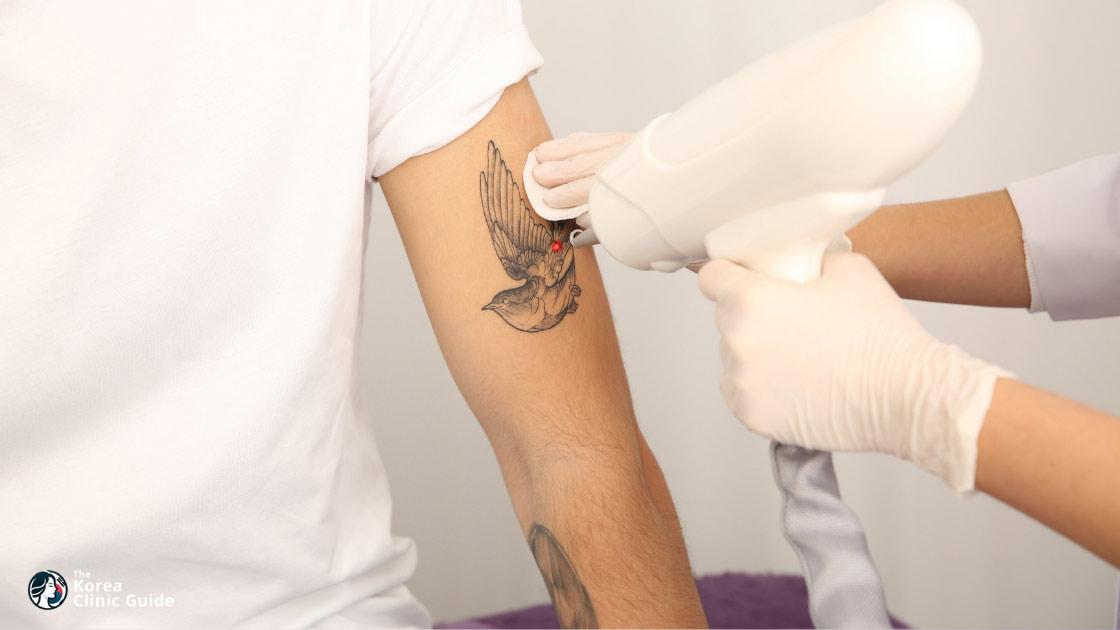 Laser Tattoo Removal in Korea (Seoul) | Best Clinics, Costs, Procedure Types & More