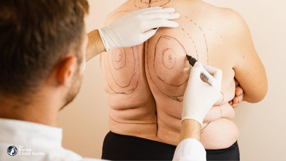 Back Liposuction in Korea | Best Clinics, Costs, Procedure Types & More