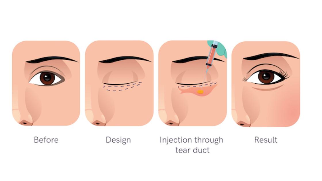 Love Band Surgery in Korea | Best Clinics, Costs, Procedure Types & More