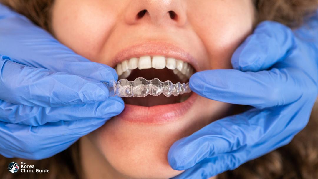 clear aligners