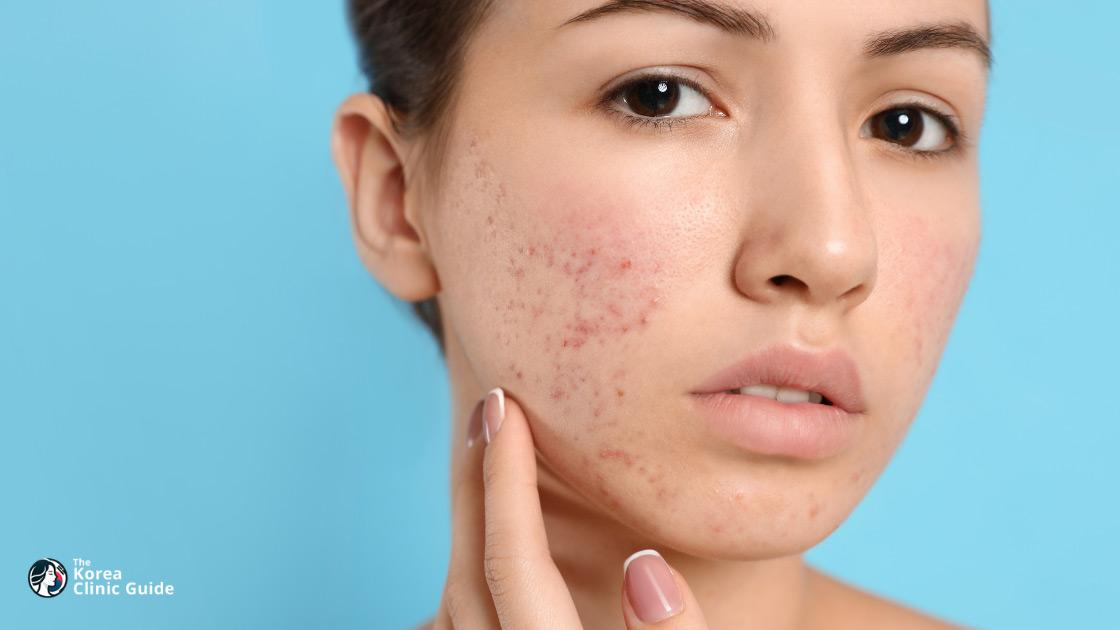 Acne Scar Treatment in Korea | Best Clinics, Costs, Procedure Types & More