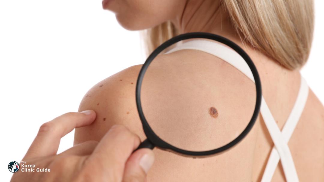 skin tag removal