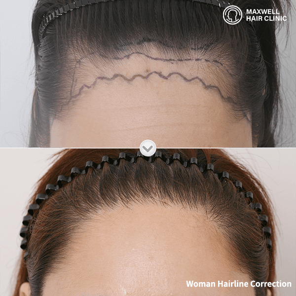 forehead reduction surgery korea