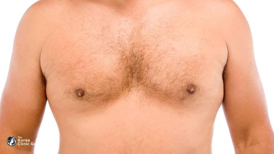 gynecomastia