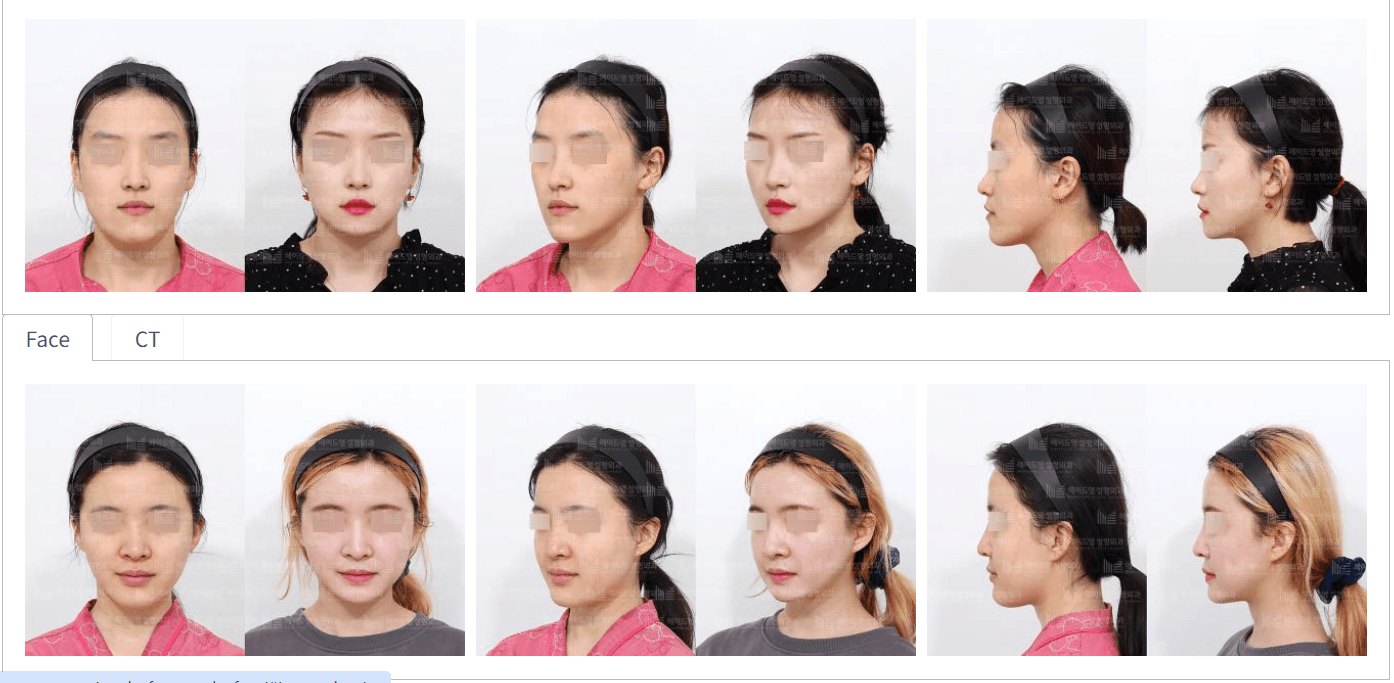 jaw surgery in korea