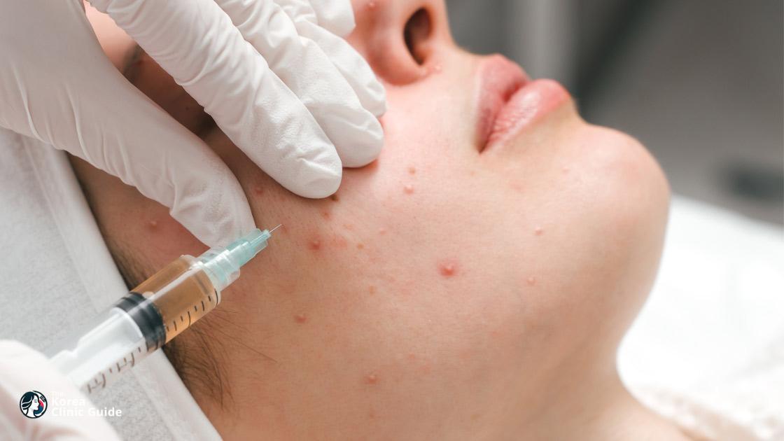 Stem Cell Acne Scar in Korea | Best Clinics, Costs, Procedure Types & More