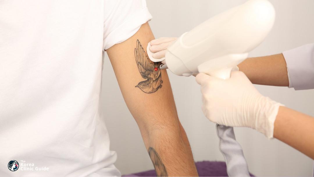 laser tattoo removal