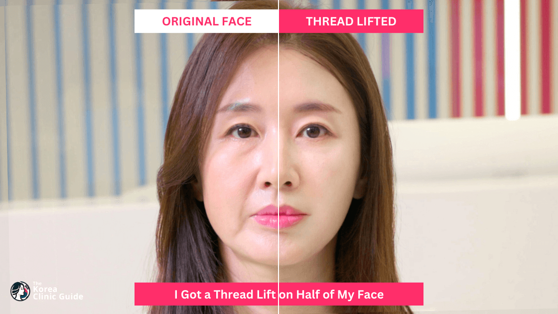 A Personal Review of Getting a Korean Thread Lift & Before After Results