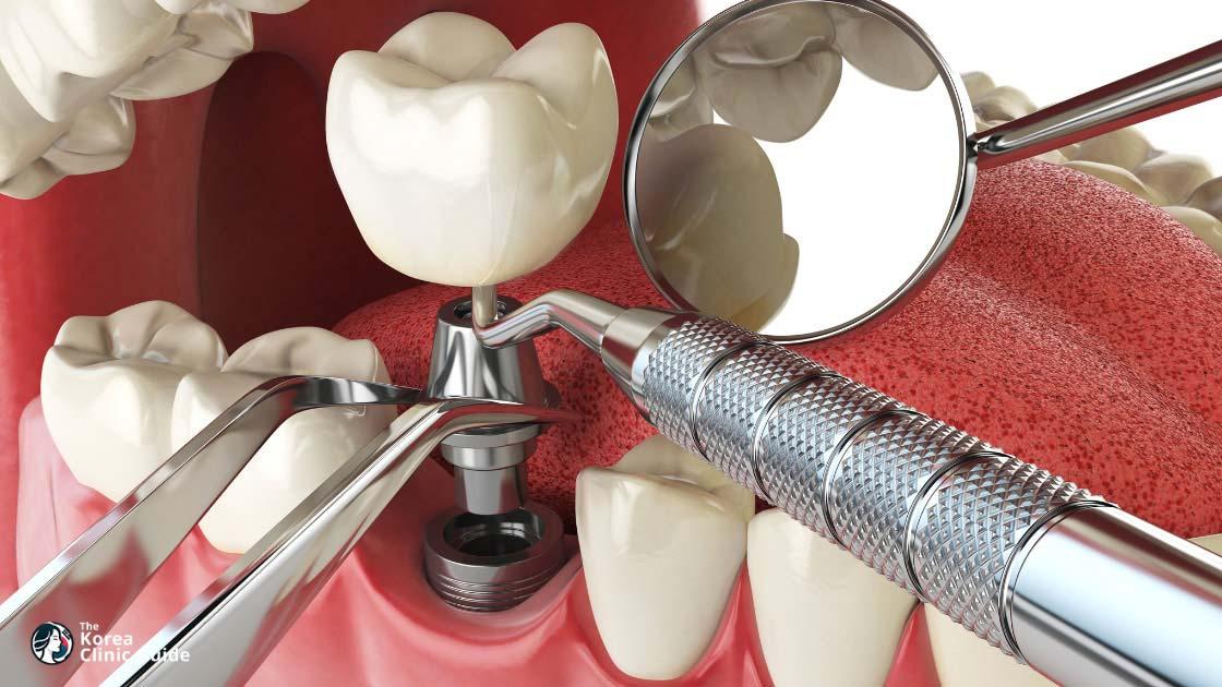 Dental Implant in Korea | Best Clinics, Costs, Procedure Types & More