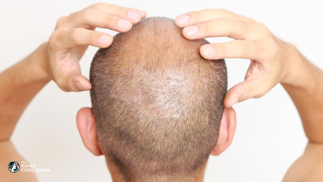 scalp micropigmentation