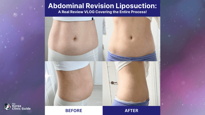 A Personal Review of Revision Abdominal Liposuction in Korea