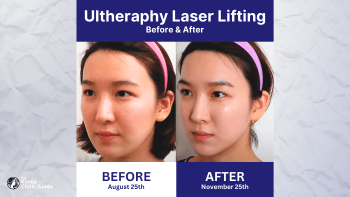 My Ultherapy Experience at Modelo Clinic in Korea (Review)