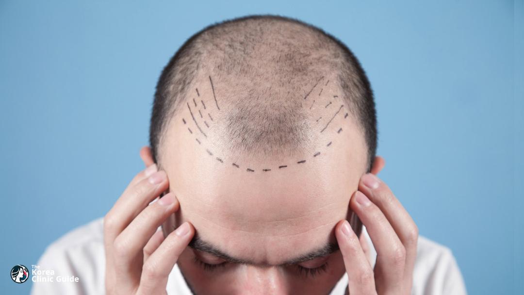 hair transplant