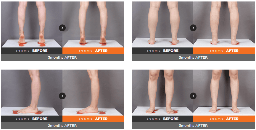 calf reduction surgery korea