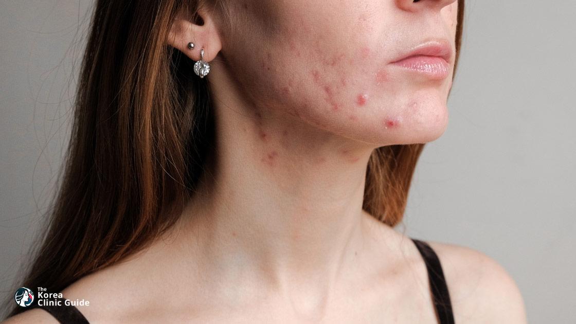 Acne Treatment in Korea | Best Clinics, Costs, Procedure Types & More