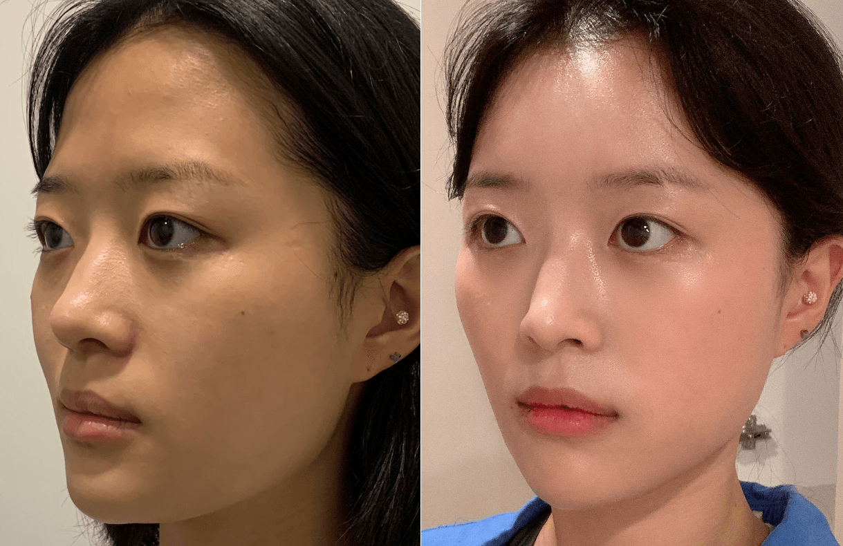 forehead reduction surgery korea