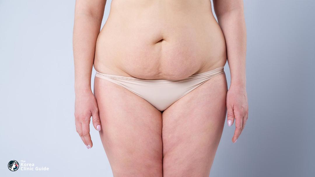 tummy tuck