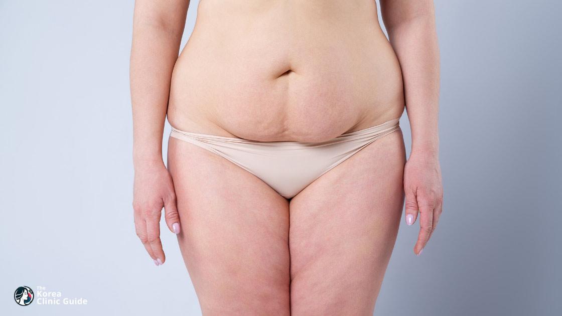 Tummy Tuck in Korea | Best Clinics, Costs, Procedure Types & More