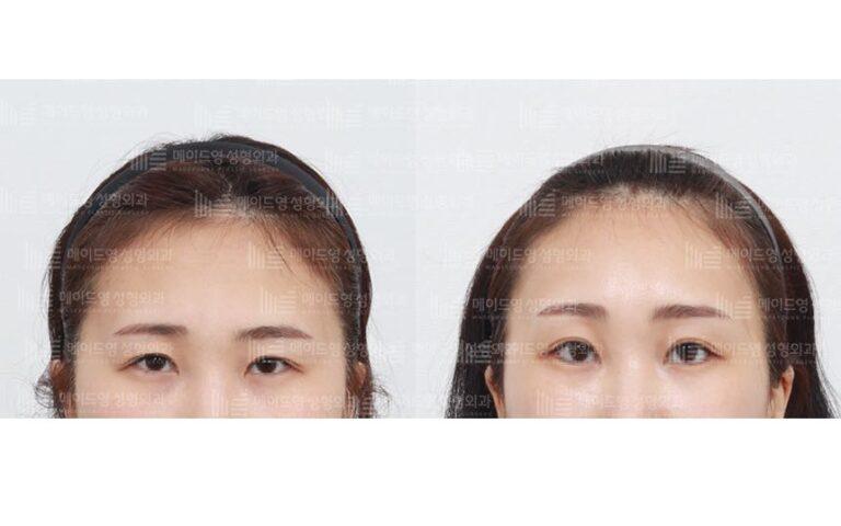 forehead reduction surgery korea