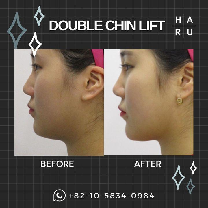 double chin tightening korea