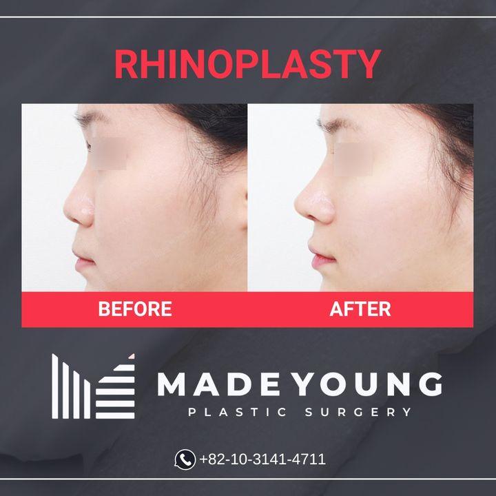 rhinoplasty korea