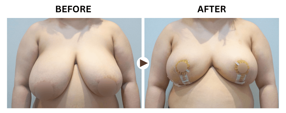 cost breast reduction korea