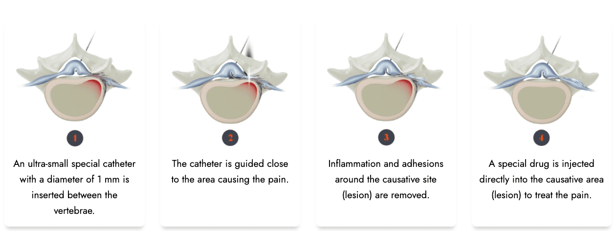 neuroplasty korea