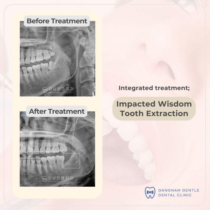 wisdom tooth removal korea