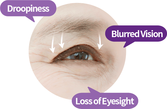 cost blepharoplasty korea