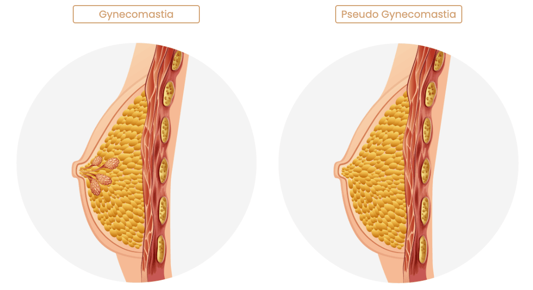 gynecomastia korea