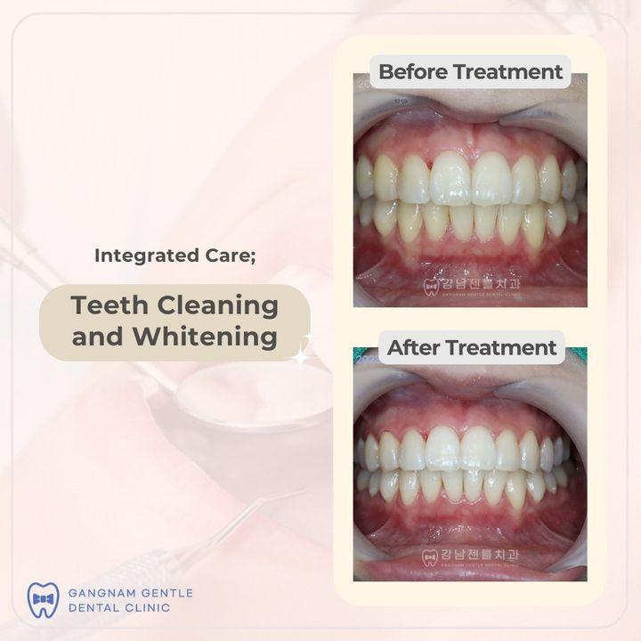 cost teeth cleaning korea