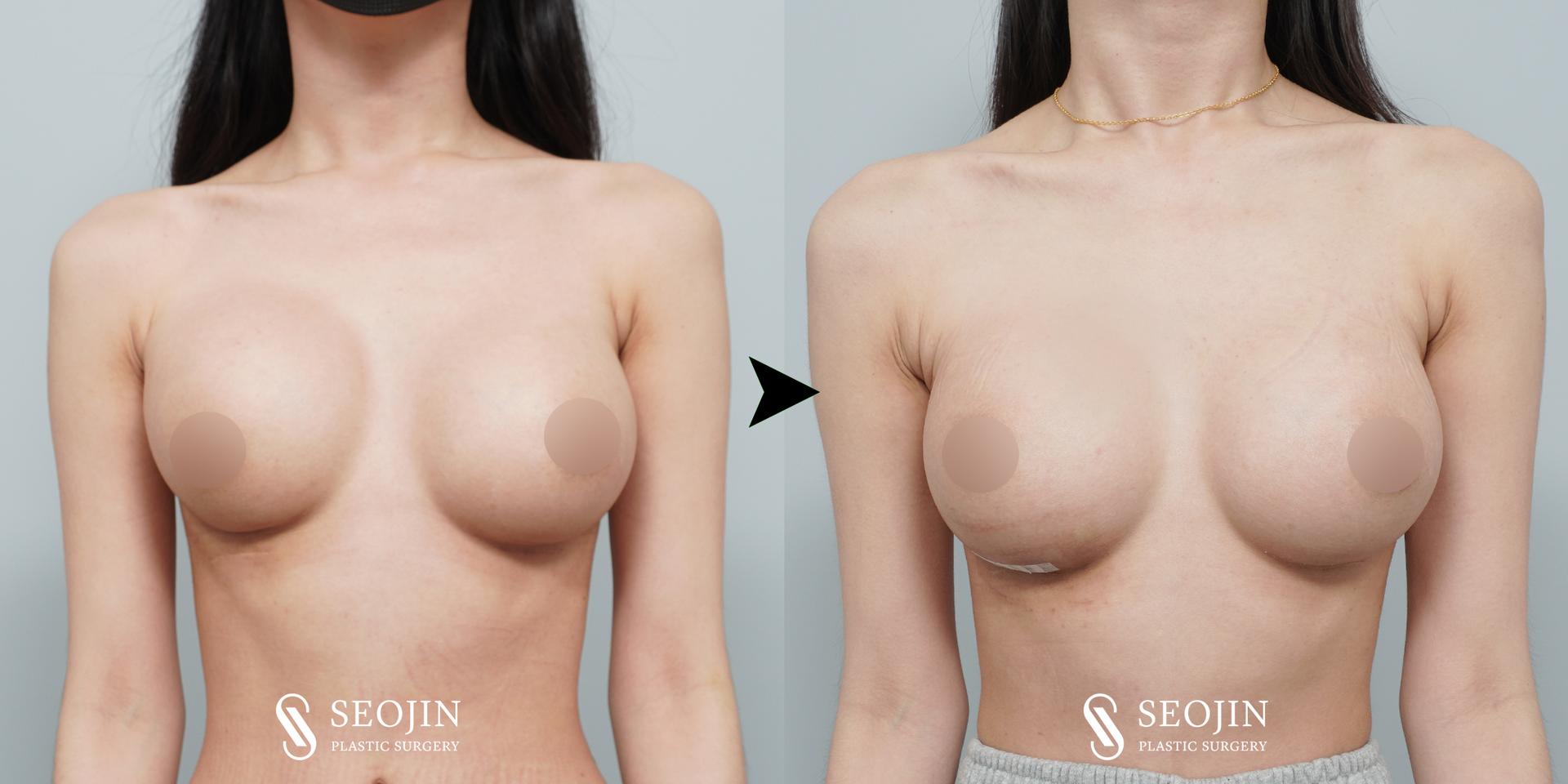 cost revision breast surgery korea