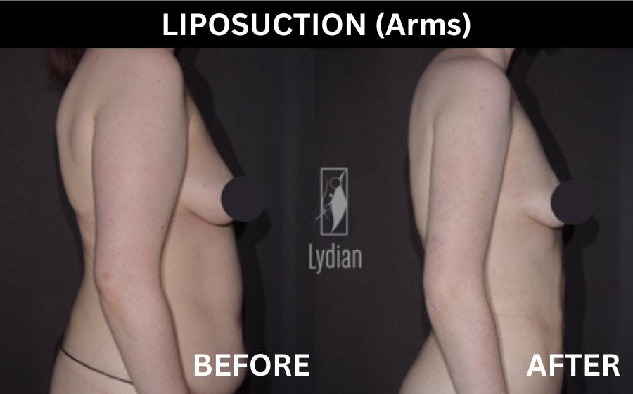 cost arm liposuction korea