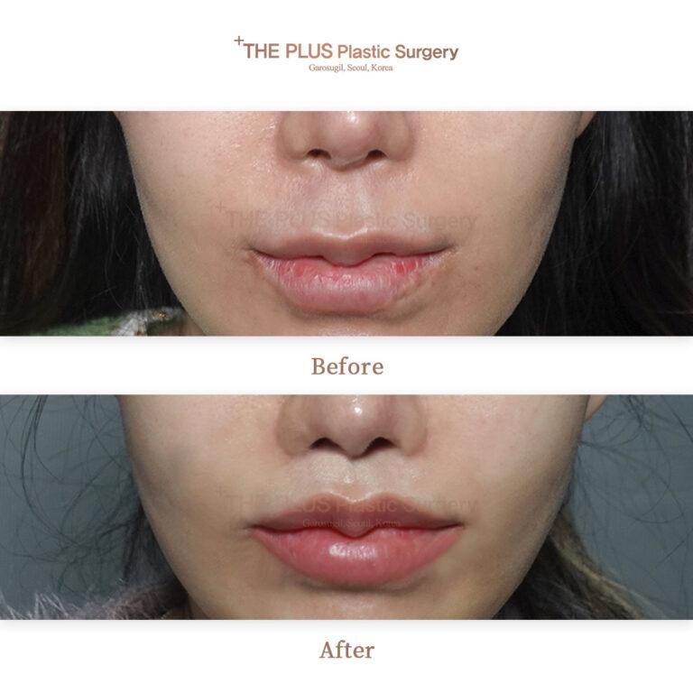 cost philtrum reduction surgery korea