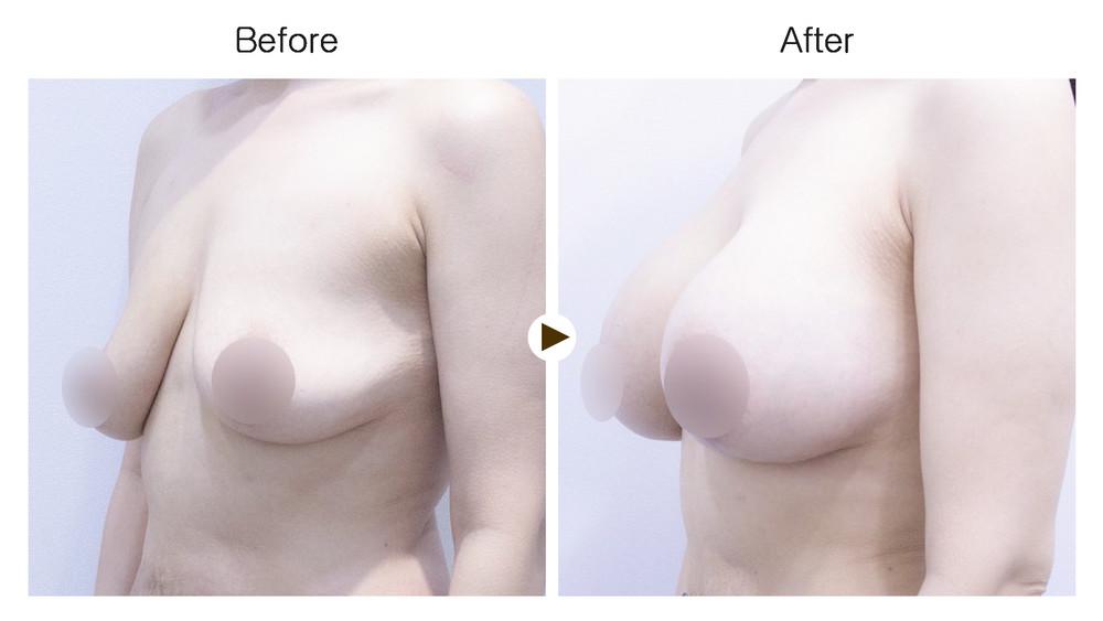 cost breast lift korea