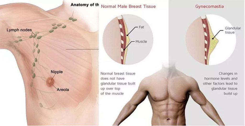 gynecomastia korea