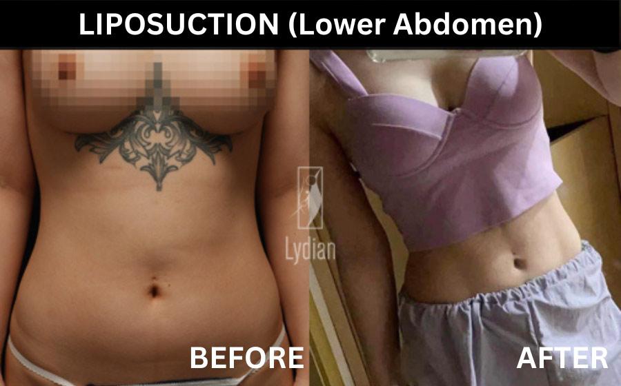 cost abdominal liposuction korea