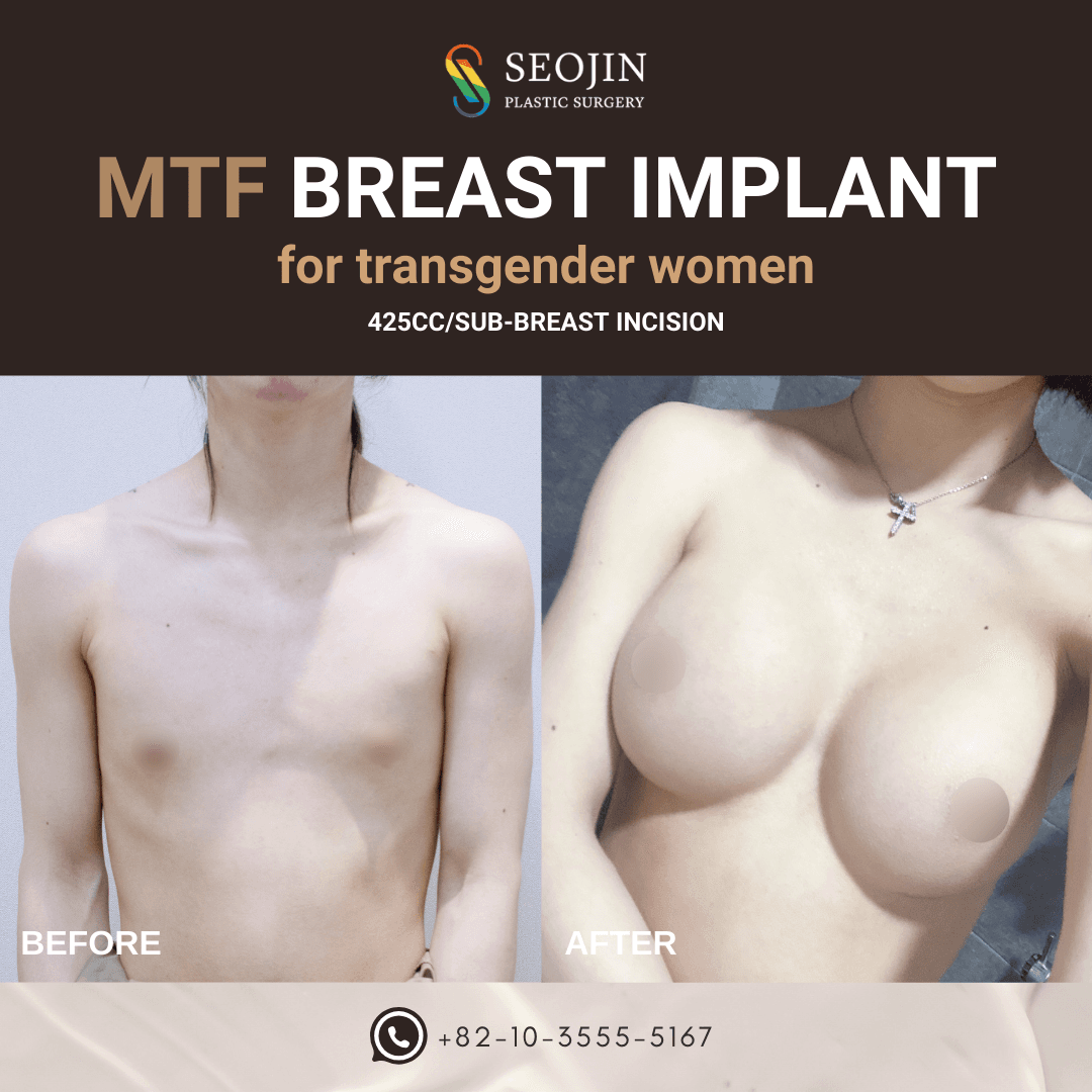 transgender breast implants korea