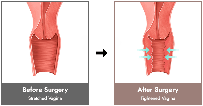 vaginoplasty korea