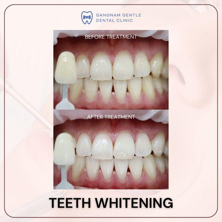 cost teeth whitening korea