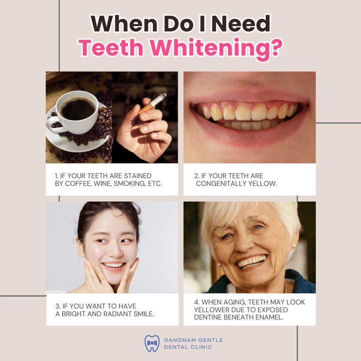 cost teeth whitening korea