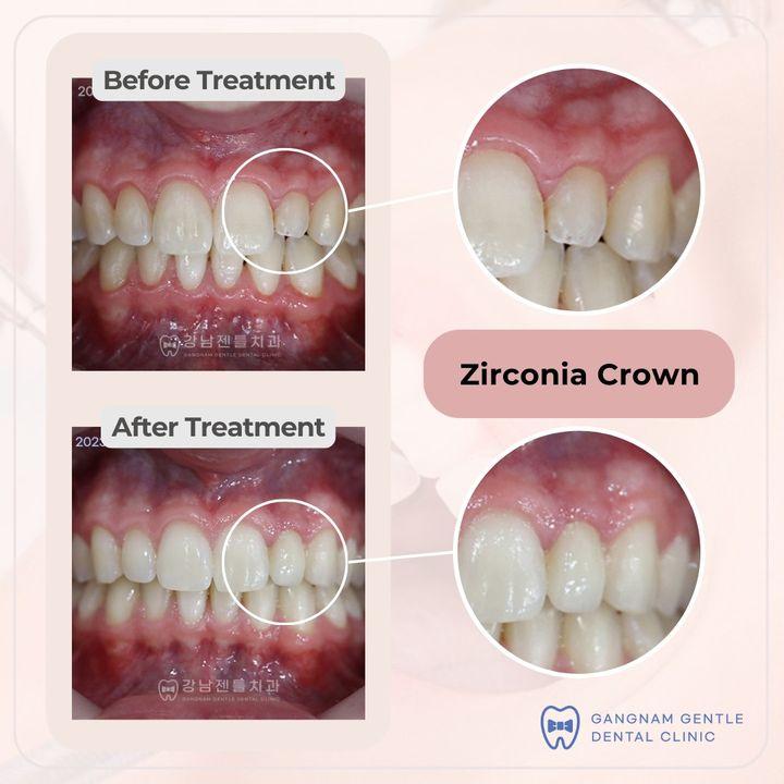 cost teeth crown korea