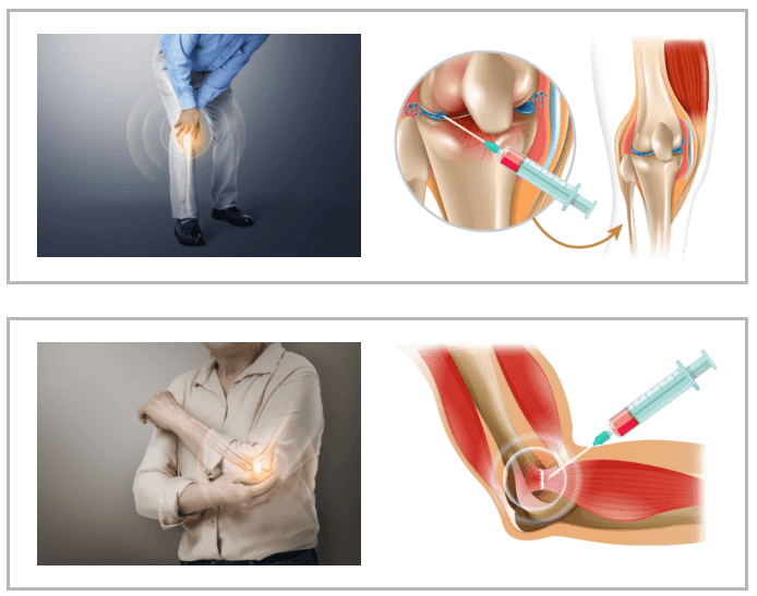 stem cells for knee cartilage regeneration korea