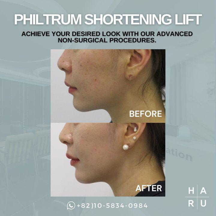 cost philtrum reduction surgery korea