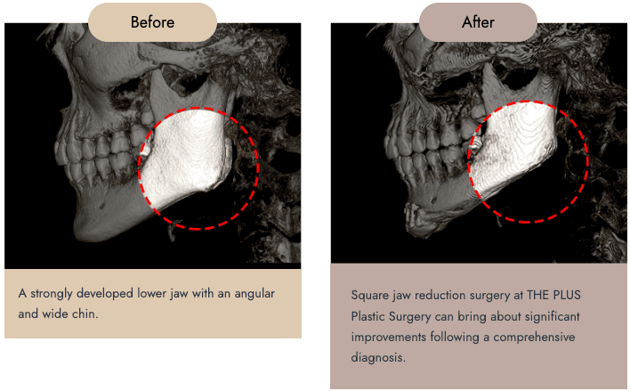 cost square jaw surgery korea