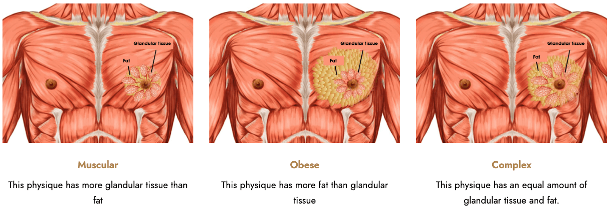 cost gynecomastia korea