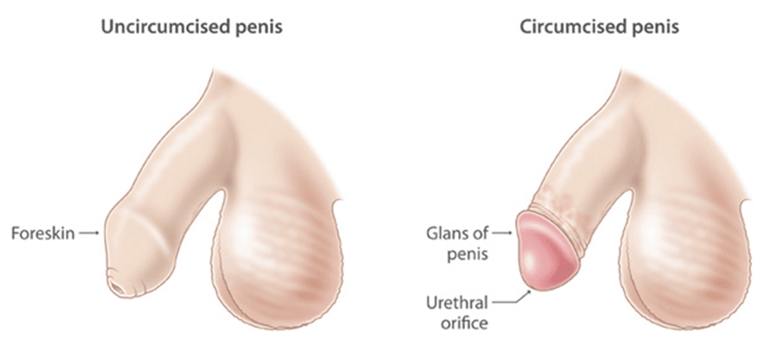 cost circumcision korea