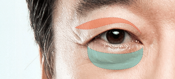 cost blepharoplasty korea