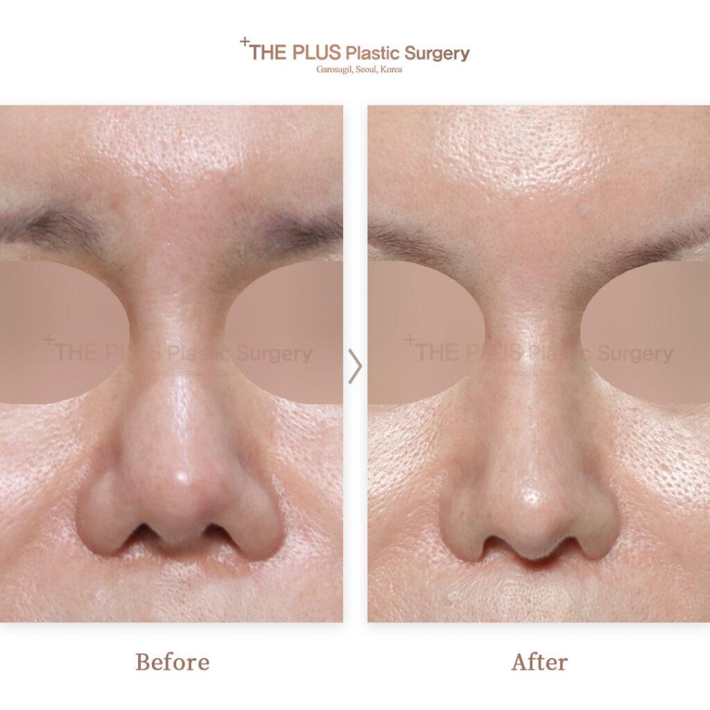 revision rhinoplasty in korea